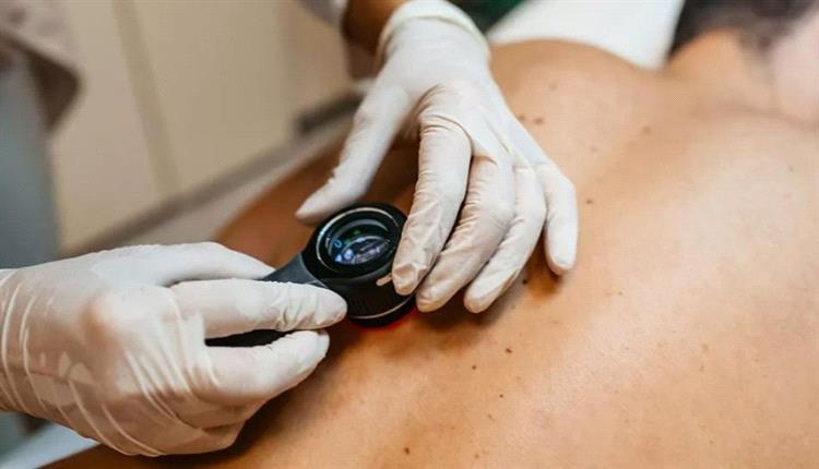 علامة على الجلد تدل على الإصابة بالسرطان
