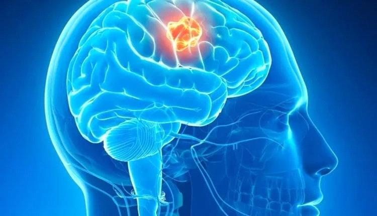 بروتين دماغي قد يكون المفتاح.. علماء يكتشفون طريقة لإبطاء أخطر أنواع السرطان
