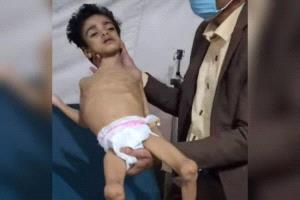 صورة مؤلمة لطفل يمني يصارع الموت بسبب الجوع في مناطق الحوثيين
