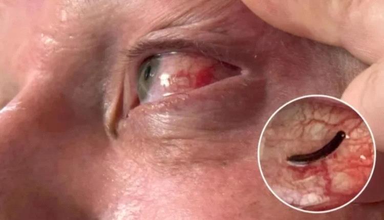 رحلة سياحية تصبح كابوساً.. دودة تتسلل إلى عين بريطاني وتتغذى على دمه
